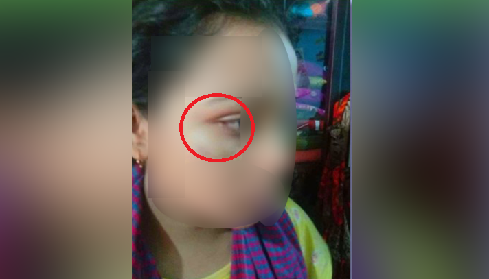 ঘুষি মেরে ছাত্রীর মুখ ফুলিয়ে দিলেন শিক্ষিকা! - the Bengali Times